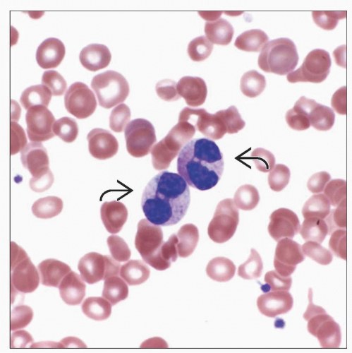 Wright Stained Peripheral Blood Smear Before A And After B