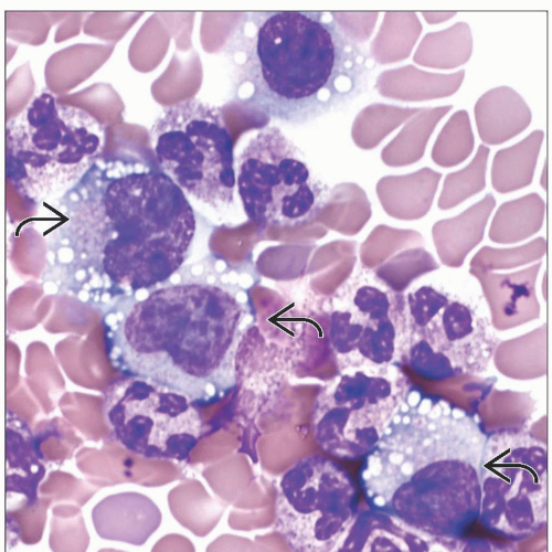 Anaplastic Large Cell Lymphoma in Blood and Bone Marrow Basicmedical Key