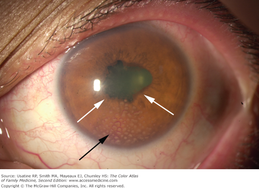 What is iritis of the eye?