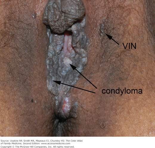 Vulvar intraepithelial neoplasia - Wikipedia