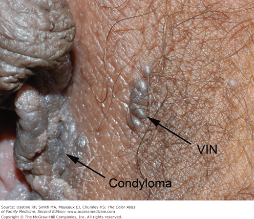 vulvar intraepithelial neoplasia pictures