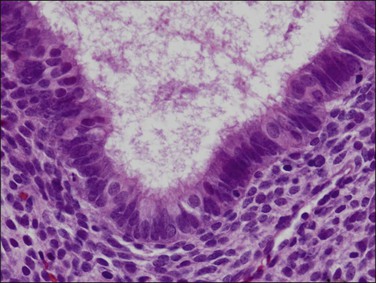 What is the treatment for disordered proliferative endometrium?