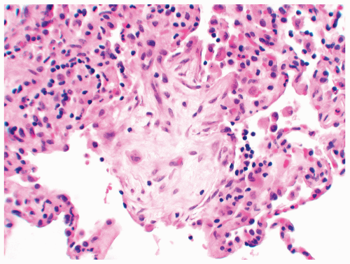 Hot Tub Lung Basicmedical Key