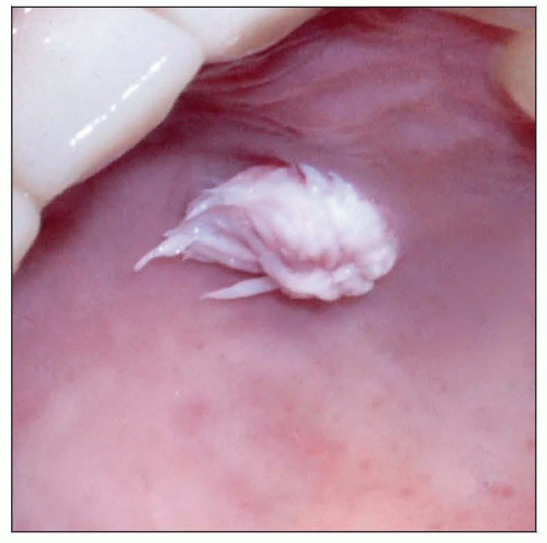 Symptomatic Squamous Papilloma of the Uvula: Report of a ...