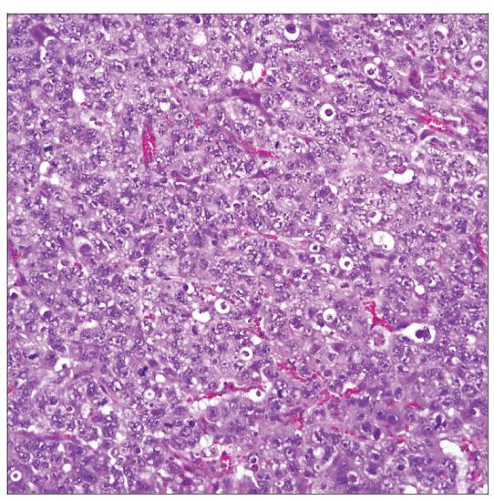 embryonal-carcinoma-basicmedical-key