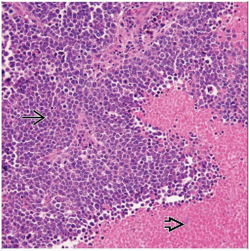 ewing-sarcoma-pnet-of-soft-tissue-basicmedical-key