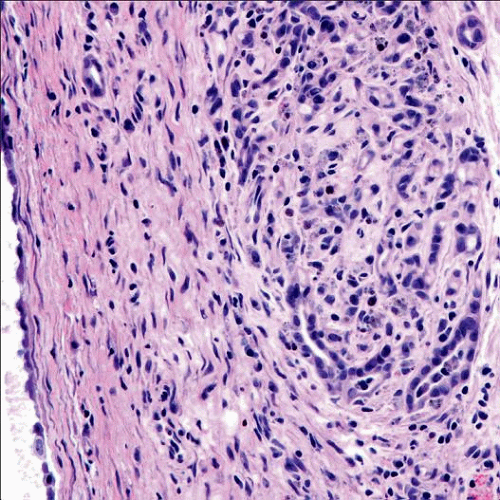 Mesothelioma Ema