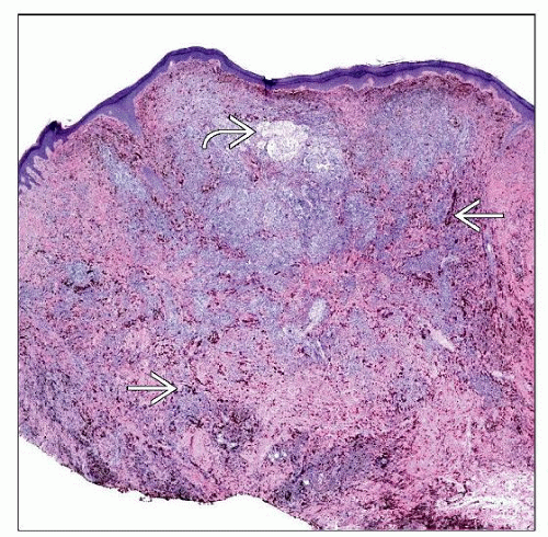 Cellular blue nevus - A challenging entity: Case report by ...
