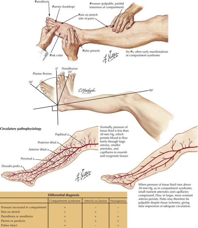Leg And Forearm Fasciotomy Basicmedical Key