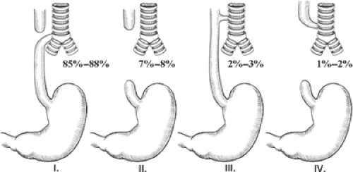 Thoracoscopic Repair Of Esophageal Atresia And Tracheoesophageal