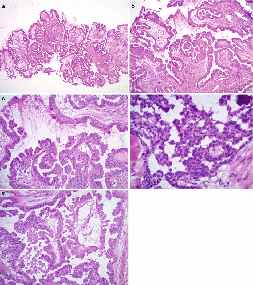 Ovarian Epithelial Tumors Basicmedical Key 