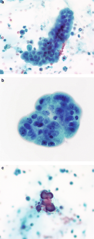 negative-for-high-grade-urothelial-carcinoma-negative-basicmedical-key