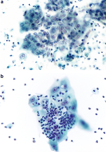 What Is Negative For High Grade Urothelial Carcinoma Nhguc