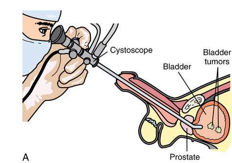 Urologic Surgery Basicmedical Key