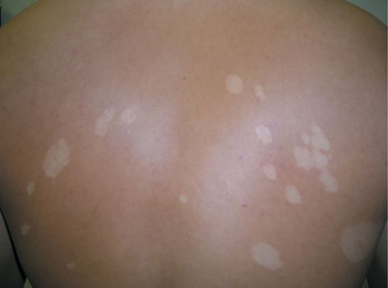 Tinea Versicolor 