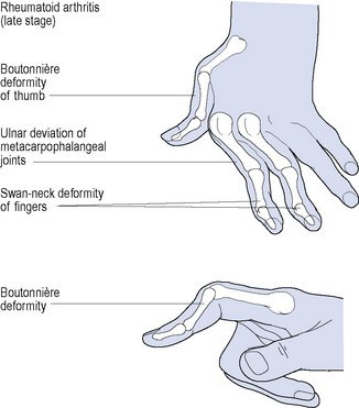 Rheumatoid arthritis and osteoarthritis | Basicmedical Key