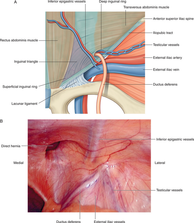 Hasselbach triangle in relation to inguinal canal | Human anatomy and  physiology, Medical anatomy, Anatomy and physiology