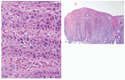 Inflammatory Disorders of the Esophagus: Reflux and ...