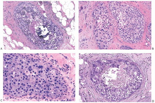 Apocrine Carcinoma | Basicmedical Key