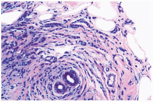 Invasive Lobular Carcinoma Basicmedical Key 