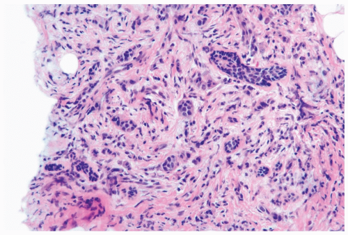 Invasive Lobular Carcinoma Basicmedical Key 1352