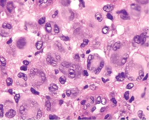 JCDR - Floret giant cells, Ropey collagen, Soft tissue neoplasm