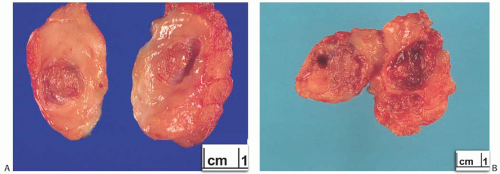 Squamous papilloma gross, Rectal squamous papilloma pathology - anunturi-click.ro
