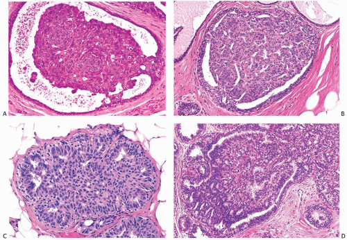 papilloma ductal hyperplasia