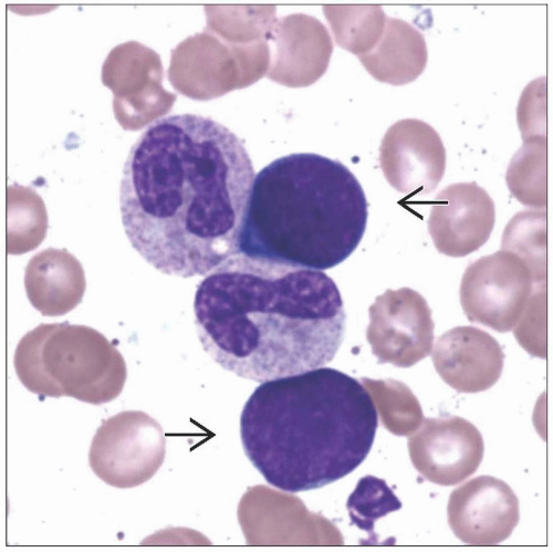 Hematogones In Bone Marrow Basicmedical Key