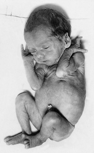 health birth problems weight low preterm weeks 1954 gestation weighing kg born he baby