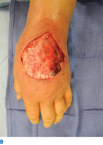 The Skin and Subcutaneous Tissue | Basicmedical Key