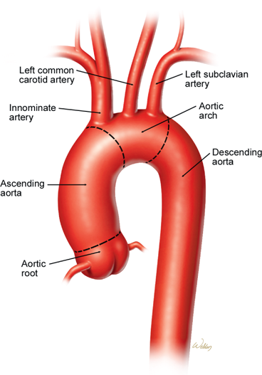 Thoracic Aneurysms And Aortic Dissection Basicmedical Key
