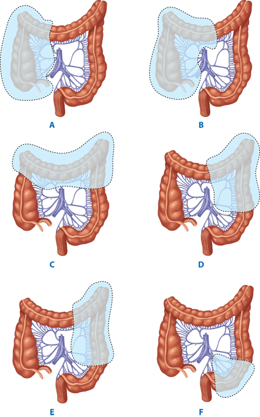 hepatic flexture resection