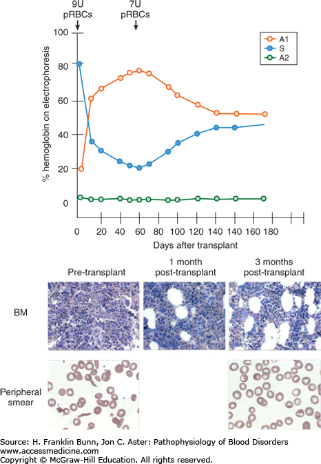 Hematopoietic Stem Cell Transplantation | Basicmedical Key