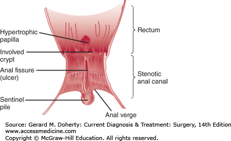 sentinel pile and anal papillae