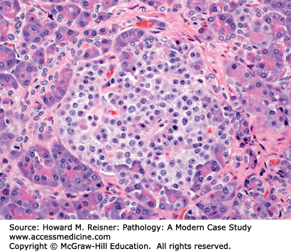 Pathology of the Pancreas | Basicmedical Key