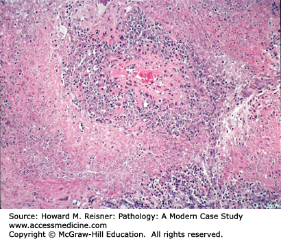 Pulmonary Pathology | Basicmedical Key