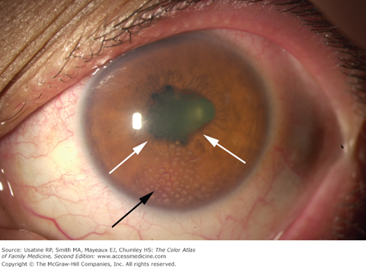 acute uveitis