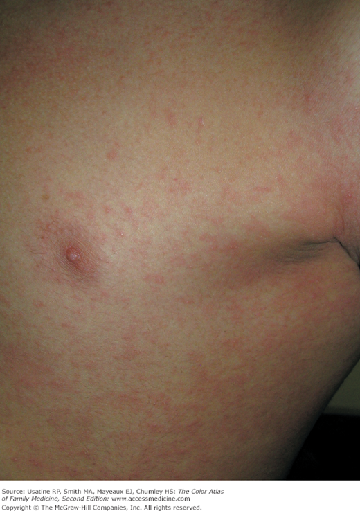 streptococcal pharyngitis rash