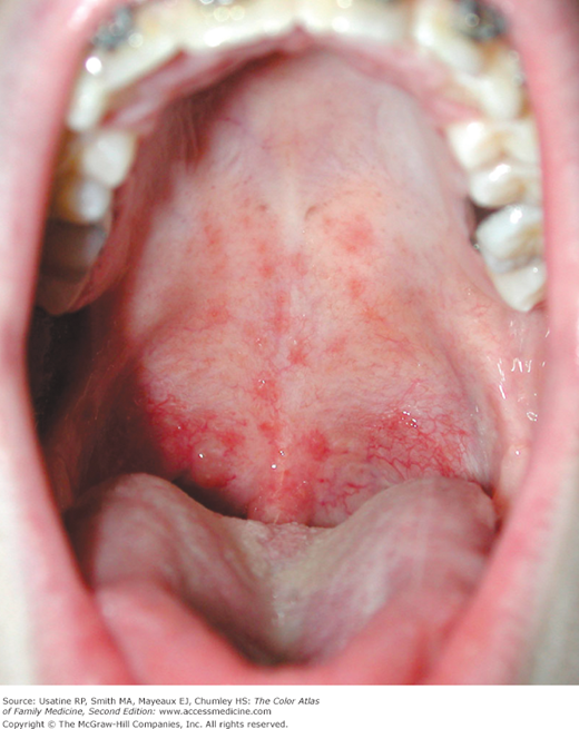 Petechiae palatal Red spots