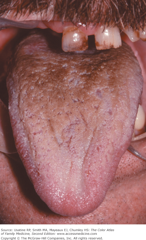 hairy tongue from chewing tobacco