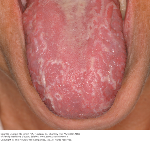 Geographic Tongue Basicmedical Key