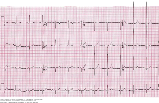 Hypertension | Basicmedical Key