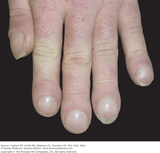 Clubbed fingers: MedlinePlus Medical Encyclopedia Image