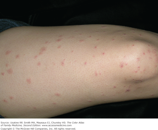 Pruritic Urticarial Papules And Plaques Of Pregnancy First Trimester