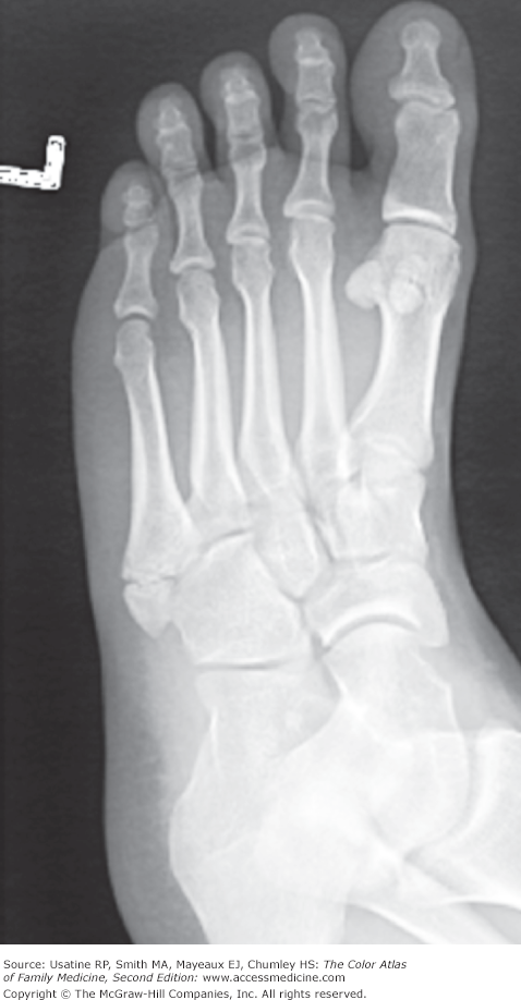 displaced 5th metatarsal fracture