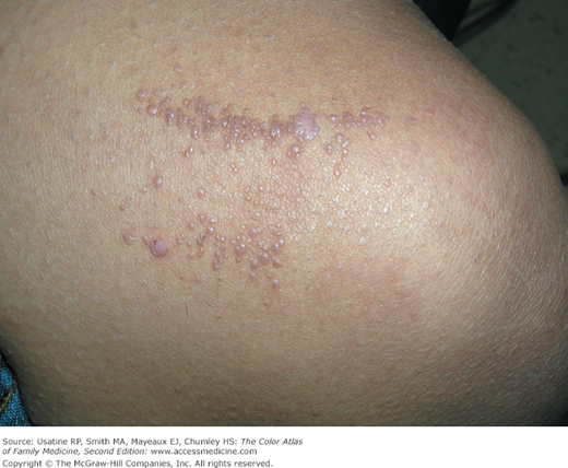 common warts on knee