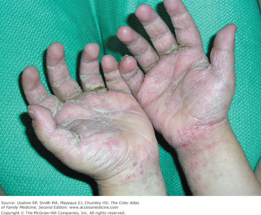 Scabies outbreaks in ten care homes for elderly people: a prospective study  of clinical features, epidemiology, and treatment outcomes - The Lancet  Infectious Diseases