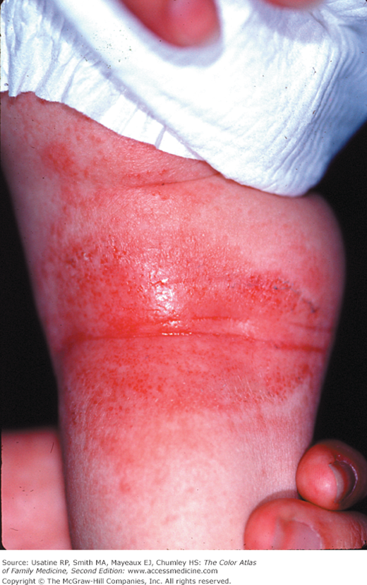 Atopic Dermatitis | Basicmedical Key