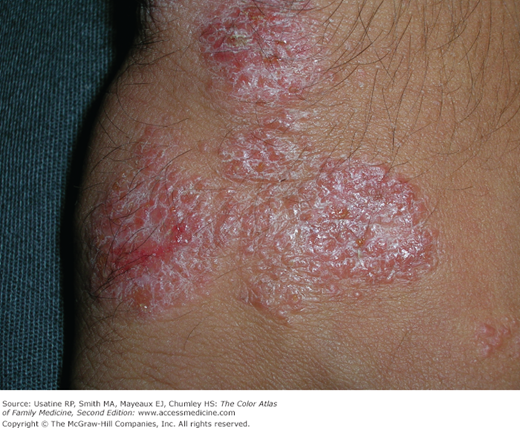 Dermatitis numularis